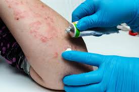 Thuốc điều trị bệnh vảy nến ở phụ nữ